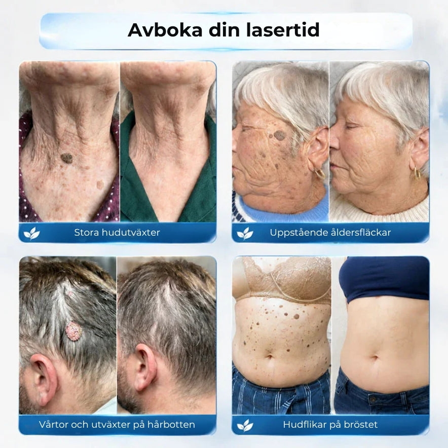 Sticka för borttagning av hudflikar och vårtor