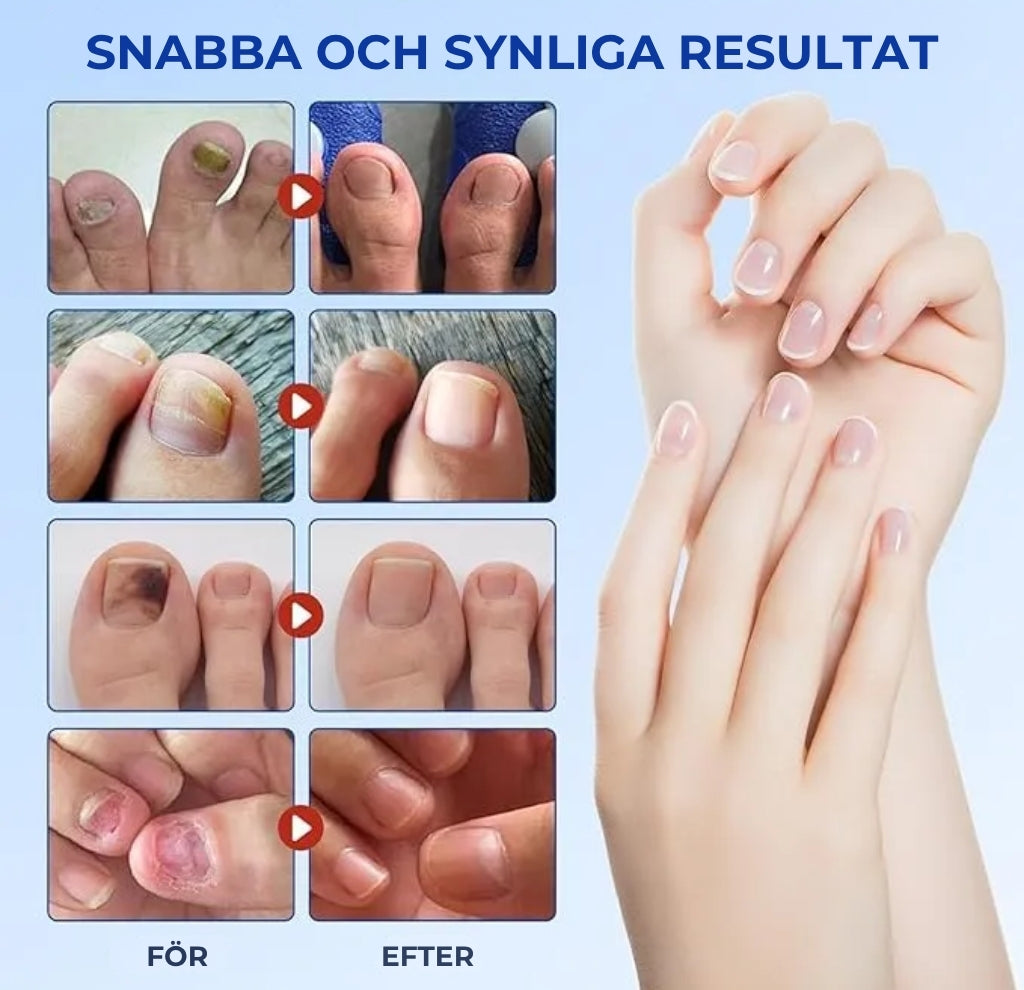 Plåster För Nagelsvamp – Snabbverkande Behandling