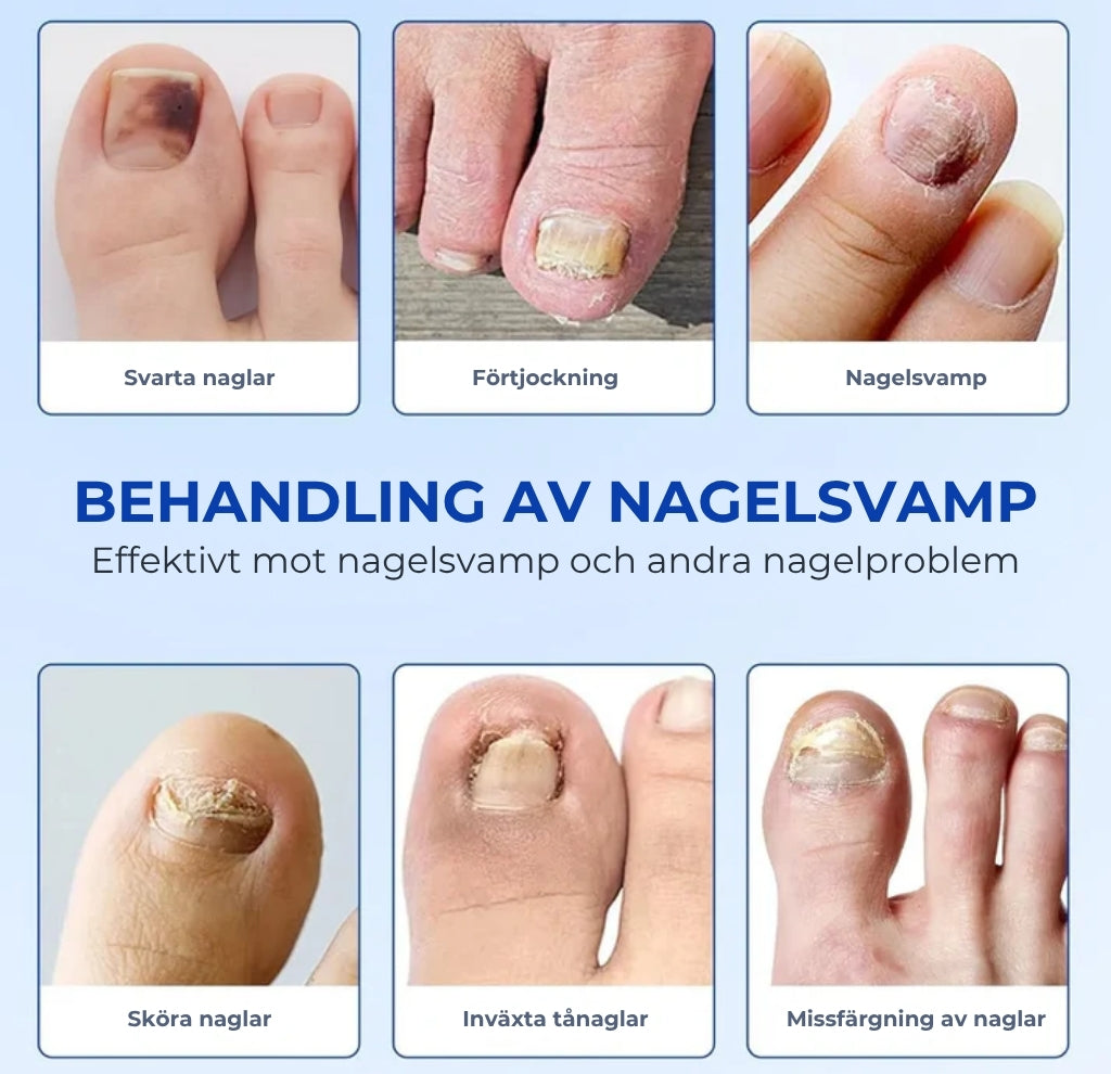 Plåster För Nagelsvamp – Snabbverkande Behandling