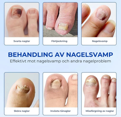 Plåster För Nagelsvamp – Snabbverkande Behandling
