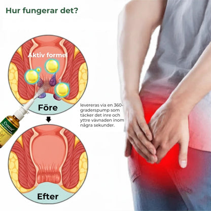 Snabbverkande örtbaserat spray mot hemorrojder