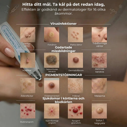 Sticka för borttagning av hudflikar och vårtor